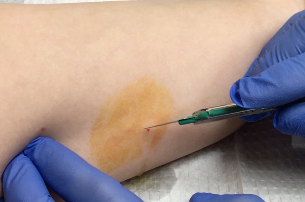 Can You Lose Weight After Nexplanon Removal?