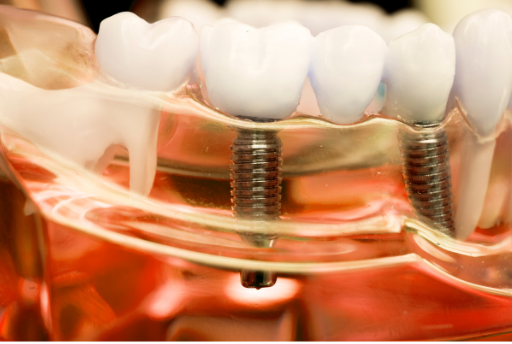 an example of a dental implant